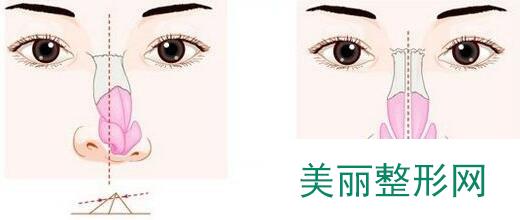 歪鼻整形要多少钱 歪鼻整形价格是多少
