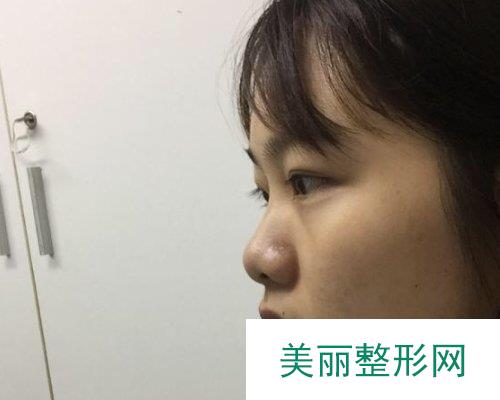 武汉忆美凯德2019鼻部整形价格表及案例展示