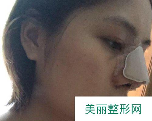 武汉忆美凯德2019鼻部整形价格表及案例展示