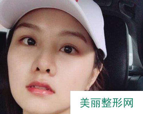 武汉忆美凯德2019鼻部整形价格表及案例展示
