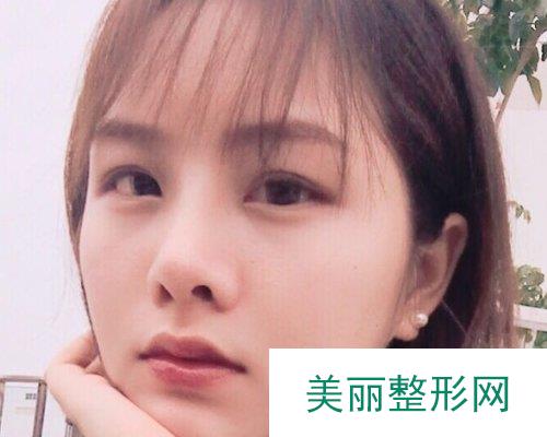 武汉忆美凯德2019鼻部整形价格表及案例展示