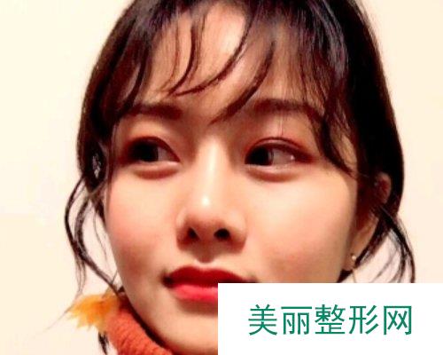 武汉忆美凯德2019鼻部整形价格表及案例展示