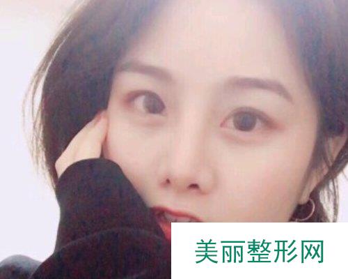 武汉忆美凯德2019鼻部整形价格表及案例展示