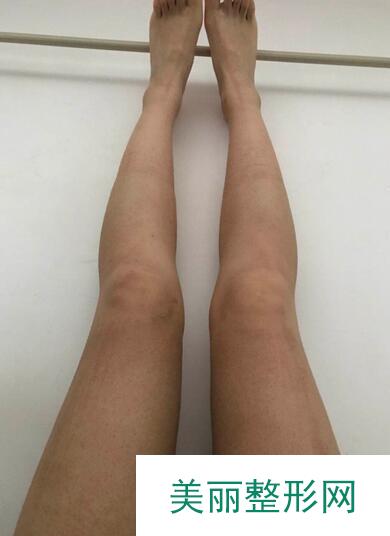 吸脂瘦全身日记来袭，小姐姐还是应该苗条一点