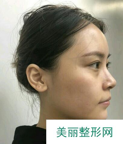 自体脂肪填充泪沟苹果肌日记分享，附上恢复照片