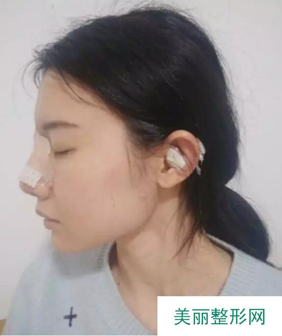 【党宁鼻翼缩小+鼻尖成形术前后对比图-见证婷婷的蜕变】