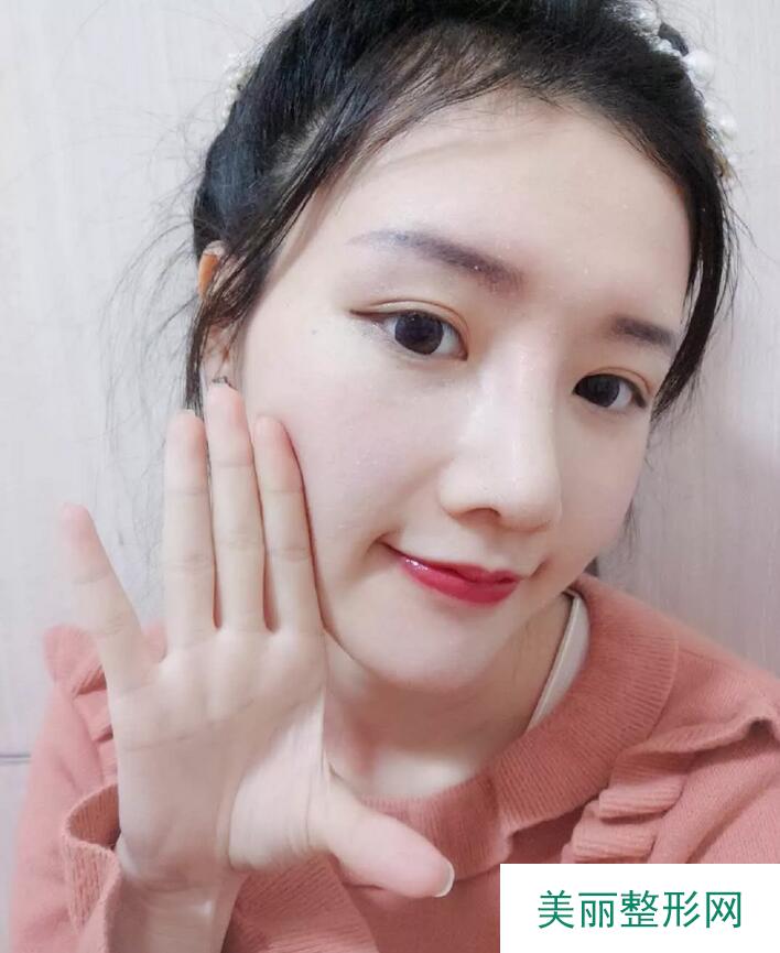 【党宁鼻翼缩小+鼻尖成形术前后对比图-见证婷婷的蜕变】
