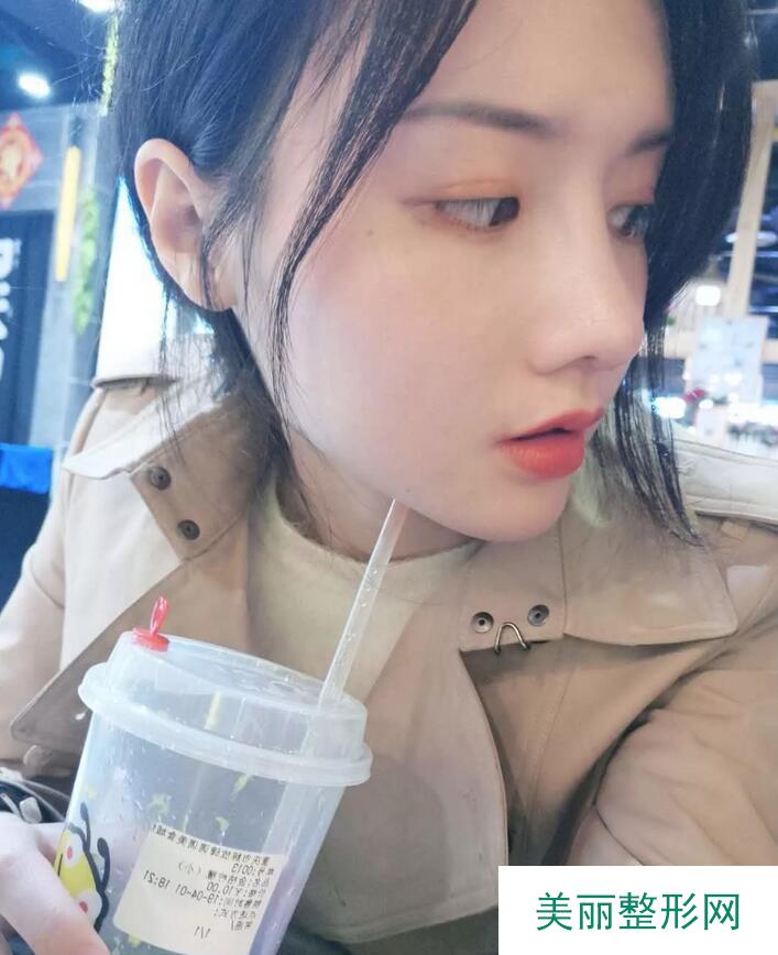 【党宁鼻翼缩小+鼻尖成形术前后对比图-见证婷婷的蜕变】