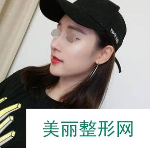 隆鼻术后第15天