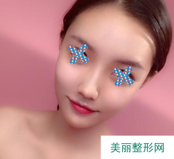 青岛博士整形医院隆鼻案例新鲜出炉！