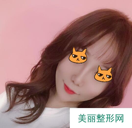 案例|软骨垫鼻尖+膨体隆鼻的术后果图