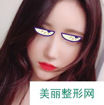 隆鼻术后