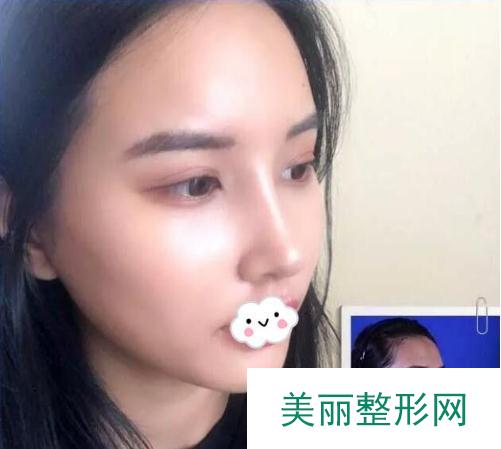 北京八大处周栩隆鼻术后对比