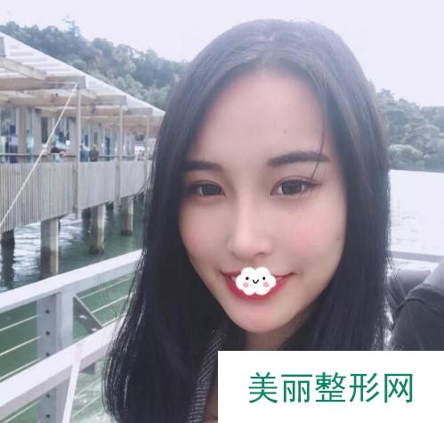 北京八大处周栩隆鼻术后3个月
