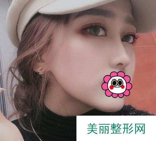 郑学东隆鼻案例术后第34天