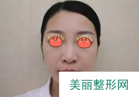 两个月前在惠州瑞芙臣做了鼻部手术隆鼻，来分享一下！