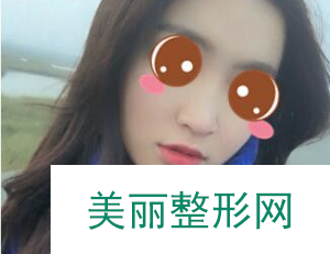 杭州东方姜颂期做鼻子怎么样？隆鼻案例70天前后对比图分享