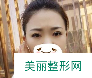 广州海峡陈子益为我做的双眼皮 30天术后果真的好极了！