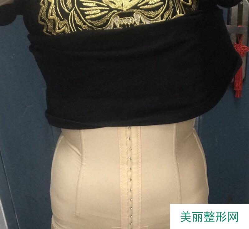 杭州格莱美陈笑医师真人吸脂案例 120天前后对比分享