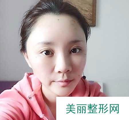 广州华美医疗美容医院自体脂肪面部填充案例