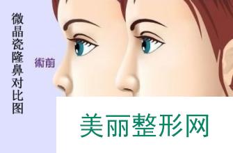 宁波珈禾整形医院微j瓷