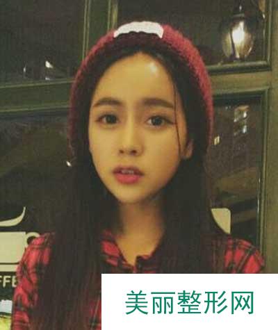 西安艺星黄凯为我做自体脂肪丰额头手术后两个月