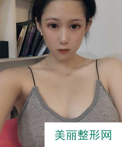 成都美莱医院吴江山为我做的假体隆胸手术后20天
