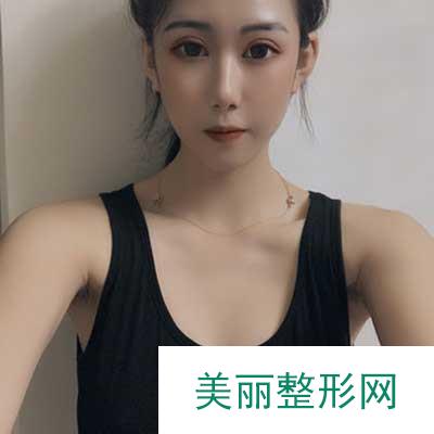 成都美莱医院吴江山为我做的假体隆胸手术前