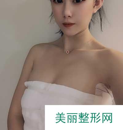 成都美莱医院吴江山为我做的假体隆胸手术后