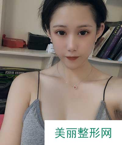 成都美莱医院吴江山为我做的假体隆胸手术后15天