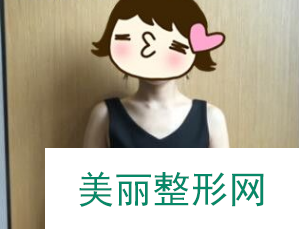 北京叶子整形李明为我做的胸 假体隆胸60天术后果实在是太好了