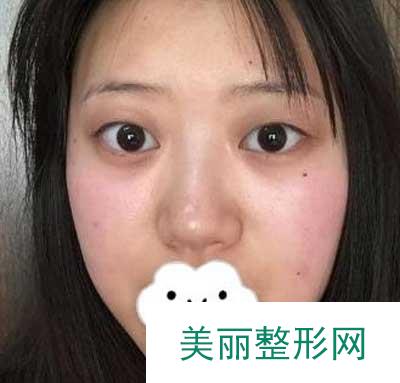 分享南京鼓楼医院整形美容科眼部手术手术案例果图