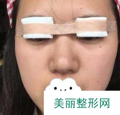 分享南京鼓楼医院整形美容科眼部手术手术案例果图