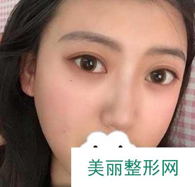 分享南京鼓楼医院整形美容科眼部手术手术案例果图