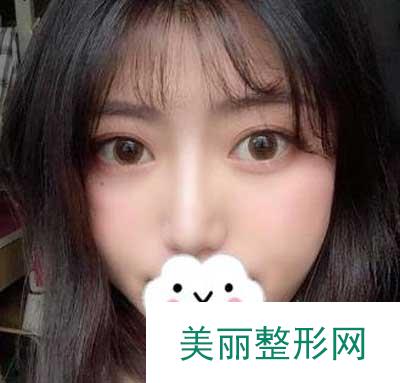 分享南京鼓楼医院整形美容科眼部手术手术案例果图