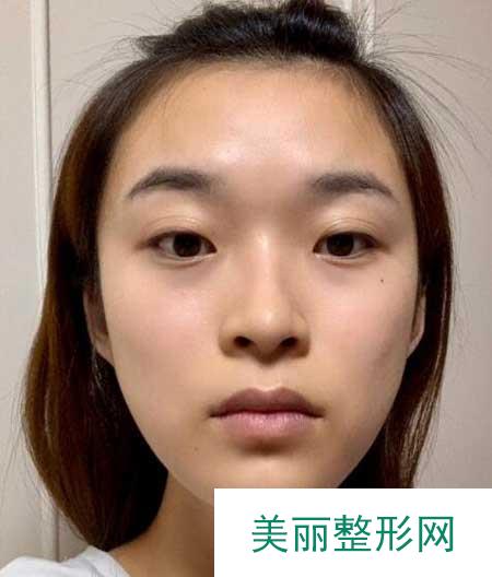 在圣嘉新做了下颌角，术后80天仙女气满满
