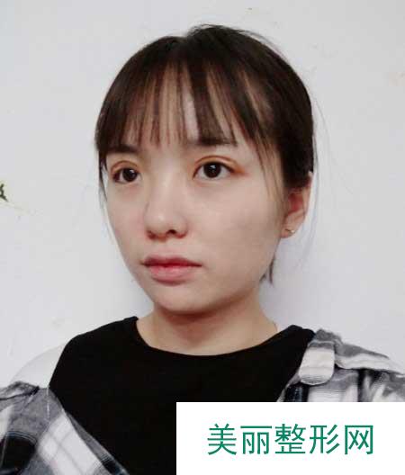 青岛市中心医院整形美容科做双眼皮案例分享