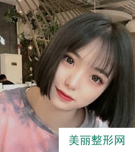 青岛市中心医院整形美容科做双眼皮案例分享