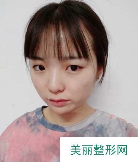 青岛市中心医院整形美容科做双眼皮案例分享