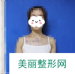 南京施尔美雷佳生隆胸怎么样？假体隆胸案例92天前后对比图分享