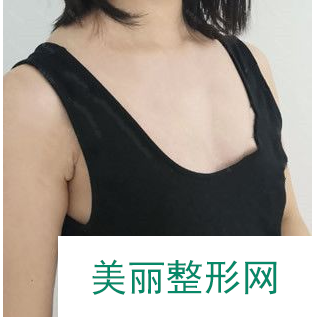找北京中日友好的曾高做的胸 假体隆胸90天果对比真的较为不错