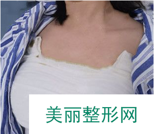 找北京中日友好的曾高做的胸 假体隆胸90天果对比真的较为不错