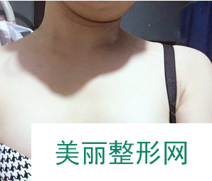 上海百达丽周珍艳为我做的胸 自体脂肪隆胸90天术后果真的太赞