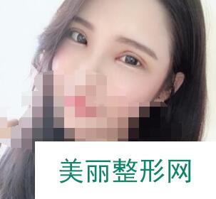 北京协和医院整形双眼皮案例