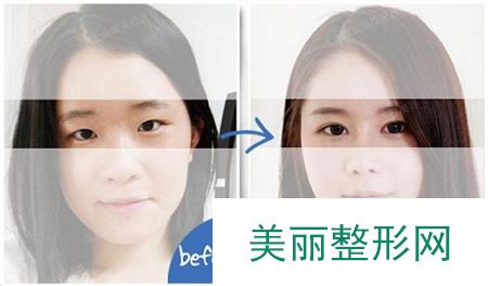 牡丹江，韩式，重睑术，多少钱