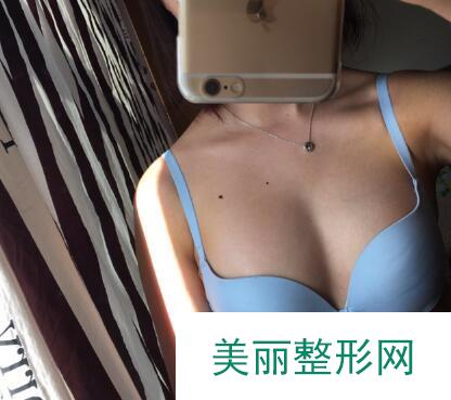 成都维莎芬整形水平怎么样？自体隆胸果对比
