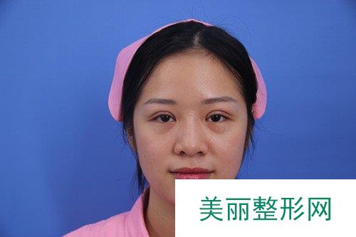 安庆市立医院整形科双眼皮案例 术后30天反馈~