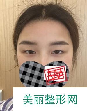 江苏省中医院整形美容科双眼皮案例 一双眼改变一张脸~