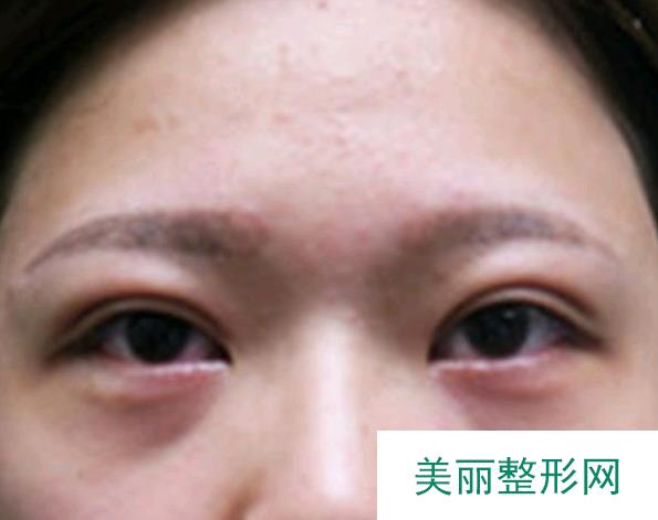 长沙湘雅医院切眼袋案例，短短15天一起来见证一下！