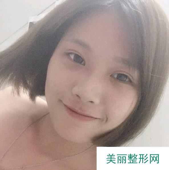 长沙湘雅医院切眼袋案例，短短15天一起来见证一下！